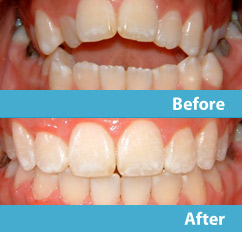 patient before and after esthetic reshaping