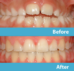 patient before and after esthetic reshaping