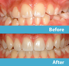 patient before and after esthetic reshaping